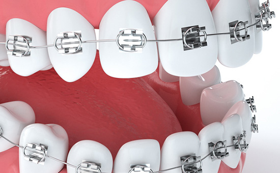 牙齿矫正