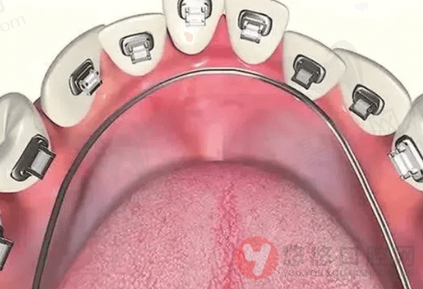 舌侧矫正技术成熟吗