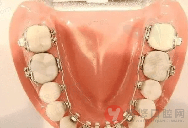 舌侧矫正一般需要多长时间完成