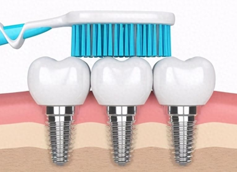 马鞍山哪家口腔医院种植牙价格合适？口碑好的牙科医院推荐