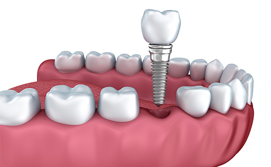 2025 南京种植牙口腔医院排名！6 家机构技术实力 + 价格对比（含集采优惠）