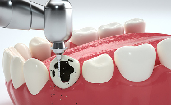 南京市口腔种牙多少钱一颗？2025 年价格解析与医院收费参考